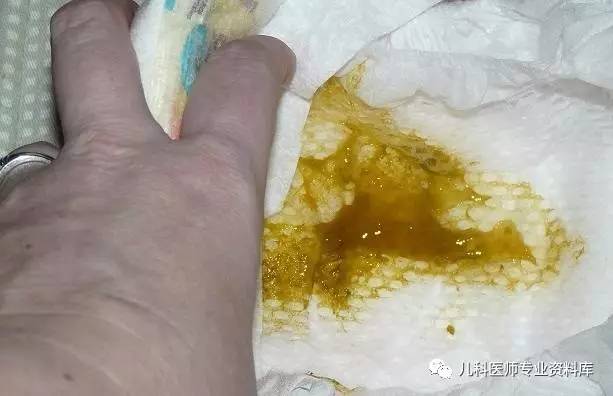 关于三个月宝宝大便出现粘液的问题解析