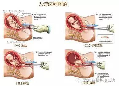 三个月能否进行无痛人流，全面解析与探讨