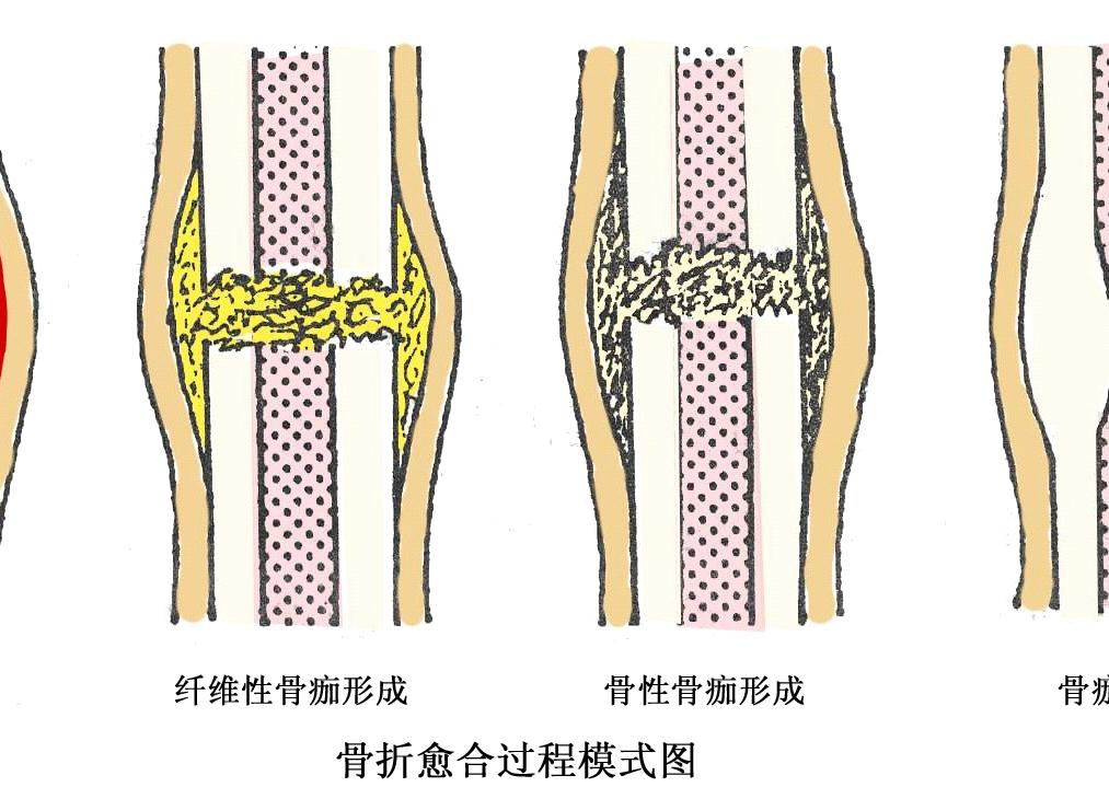 耻骨骨折的愈合过程，几个月内骨痂的形成与成长